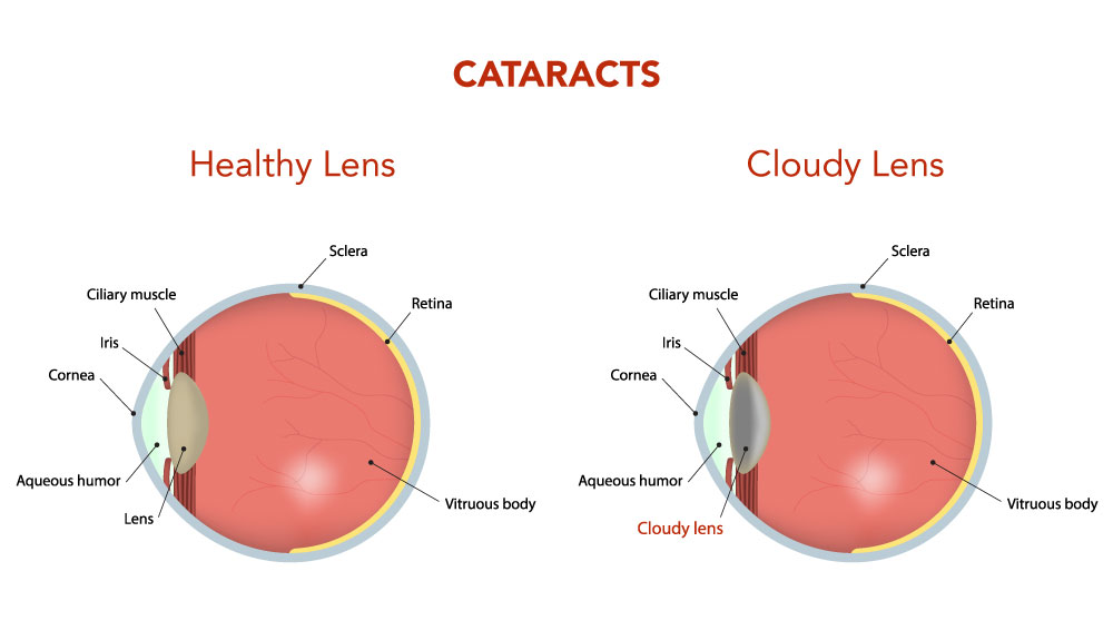 Surgery cataract Cataract Surgery